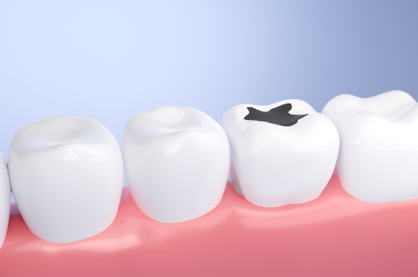 むし歯・歯周病になりやすくなる